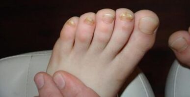 Trichofitas yra raudonas